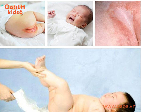 Hăm tã có thể tái phát nhiều lần ở trẻ