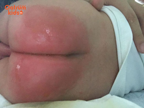 Chủ quan, lơ là, coi thường bệnh là nguyên nhân khiến hăm tã ở trẻ thêm nặng và dai dẳng