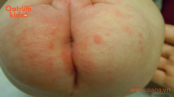 Hăm tã là bệnh lý thường gặp ở trẻ