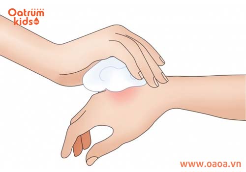 Chườm đá lên vùng da bị côn trùng đốt của trẻ để giảm nhanh triệu chứng đau rát