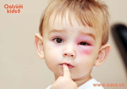 Bé bị côn trùng đốt thường xuất hiện dấu hiệu: ngứa, sưng đỏ…