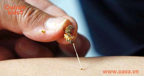 Lấy ngòi độc của côn trùng ngay khi trẻ bị đốt