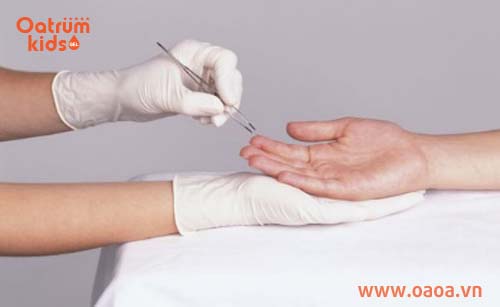 Dùng dụng cụ chuyên dụng lấy nọc độc ra