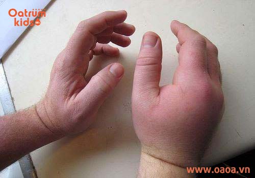 Trẻ bị côn trùng đốt sưng phù nếu không điều trị kịp thời sẽ gây biến chứng nguy hiểm