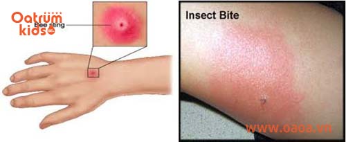 Khi trẻ bị côn trùng cắn cần dùng nhíp nhổ ngòi độc ra luôn