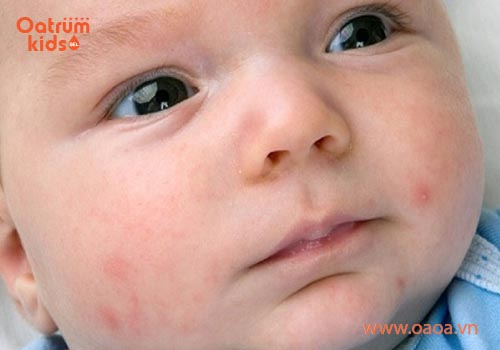 Mụn nhọt rất phổ biến ở trẻ sơ sinh và trẻ nhỏ