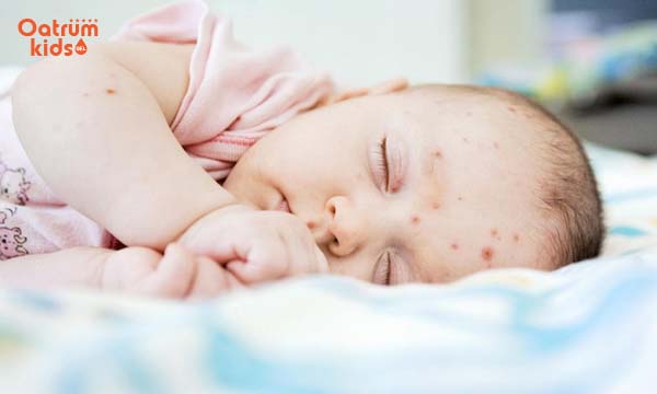 Mụn nhọt thông thường thì không nguy hiểm