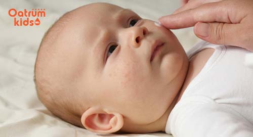 Cách làm mụn nhanh chín ở trẻ ngay tại nhà