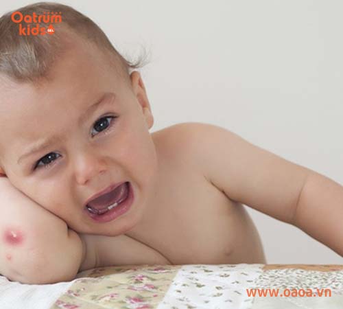 Mụn nhọt ở trẻ không hề đơn giản như nhiều cha mẹ vẫn nghĩ