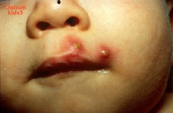 Thận trọng khi trẻ bị mụn đinh râu