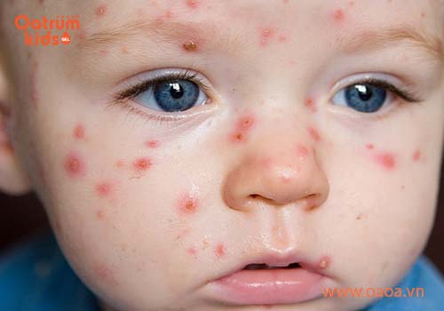 Rất nhiều trẻ bị mụn nhọt ở mặt