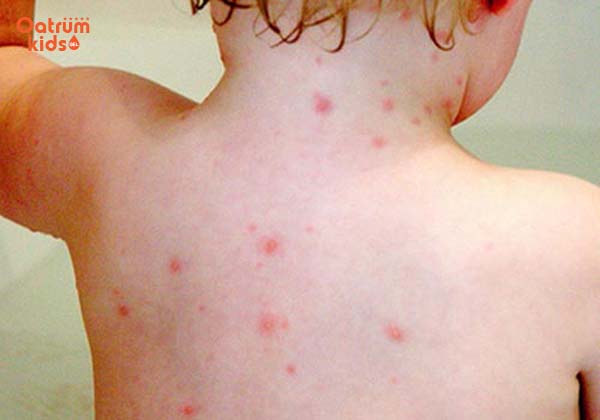 Mụn nhọt ở trẻ hoàn toàn có thể điều trị tại nhà