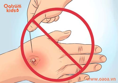 Tuyệt đối không tự ý chích, nặn mụn nhọt sưng tấy ở trẻ