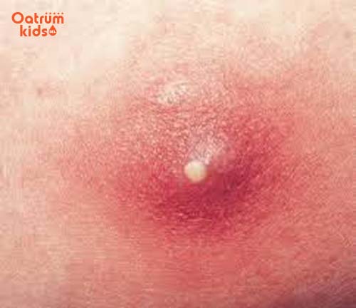 Mụn nhọt sưng tấy ở trẻ do tụ cầu khuẩn gây nên