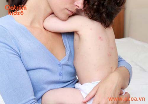 Trẻ bị mụn ở lưng do nhiều yếu tố tạo thành