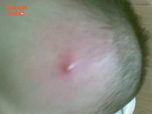 Nhiều trẻ bị viêm màng não, nhiễm khuẩn huyết vì mụn nhọt