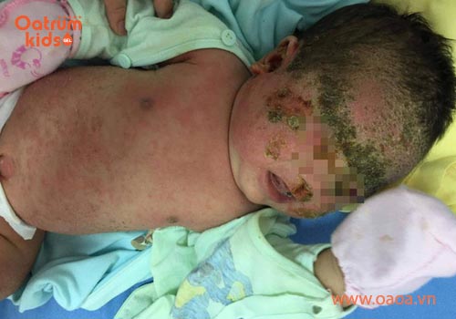 Tuyệt đối không đắp các loại lá cây cỏ không đảm bảo cho trẻ bị mụn nhọt