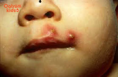 Mụn nhọt có thể to như quả trứng gà