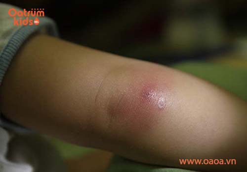 Nguyên nhân gây mụn nhọt - Mụn nhọt ở trẻ là do vi khuẩn gây ra