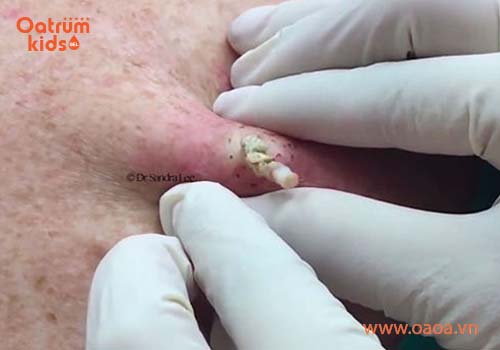 Không nên tự ý nặn mụn nhọt cho trẻ