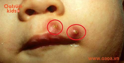 Mụn nhọt gây nhiễm trùng huyết ở trẻ nếu không điều trị kịp thời