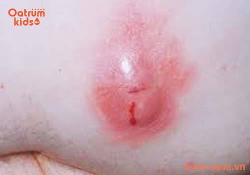 Vùng da bị mụn nổi cục sưng đỏ, chứa nhiều mủ