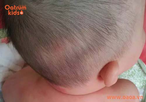 Trẻ nổi mụn nhọt trên đầu không hẳn do nóng trong gây nên