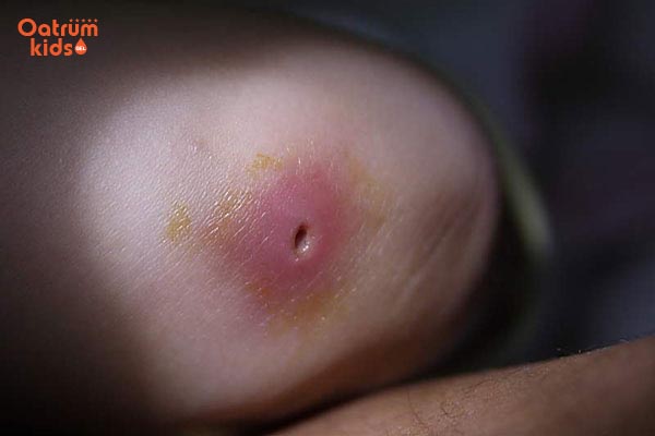 Nhọt nguy hiểm hơn mụn