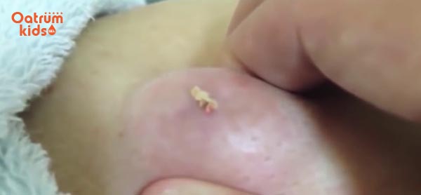 Tuyệt đối không tự ý nặn mụn nhọt ở trẻ