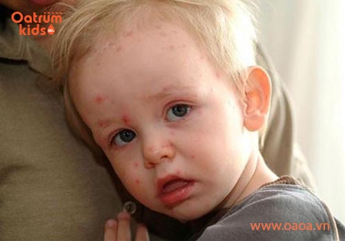 Trẻ dưới 3 tuổi rất hay bị mụn nhọt