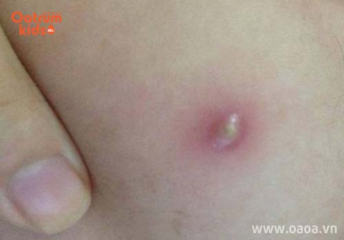 Trẻ bị mọc mụn đầu đinh ở mông thường xuất hiện một hoặc nhiều cái