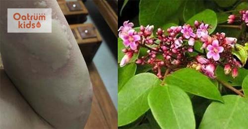 3 CÁCH CHỮA MỀ ĐAY BẰNG LÁ KHẾ CỰC ĐƠN GIẢN