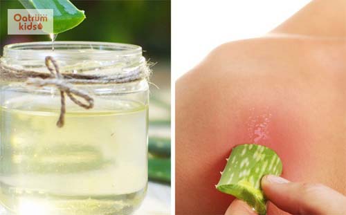 4 cách chữa bỏng bô xe máy không để lại sẹo an toàn nhất