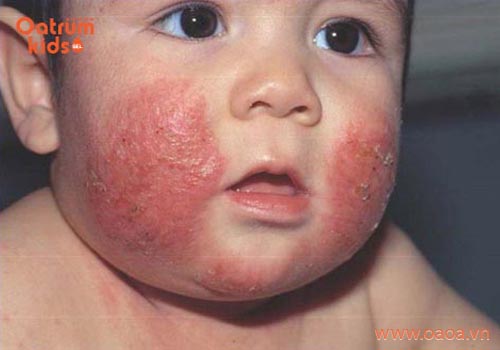 5 nguyên nhân khiến trẻ sơ sinh bị nổi mẩn đỏ ở cổ và mặt