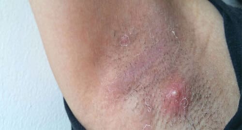 Ai bị mụn mủ ở nách đọc ngay để biết cách điều trị hiệu quả