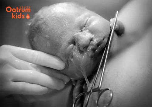 Bạn biết gì về hiện tượng đẻ bọc điều?