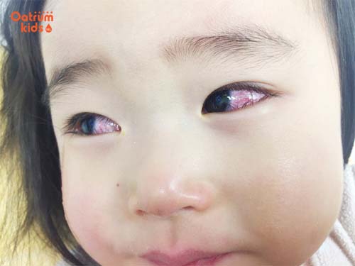 Bạn đã tìm hiểu bệnh Kawasaki là gì và có nguy hiểm?