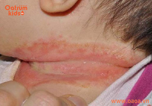 Bé bị hăm cổ phải làm sao cho mau khỏi?