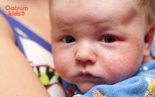 Bé bị mẩn đỏ hai má và những nguy hiểm khôn lường