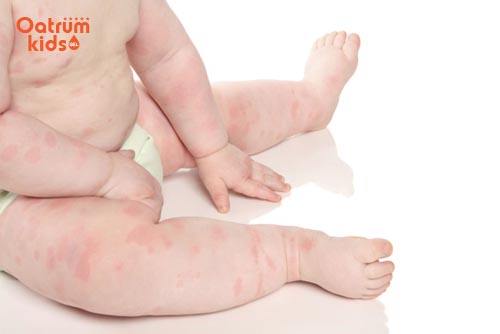 Bé bị mẩn ngứa khắp người tắm lá gì cho mau khỏi?