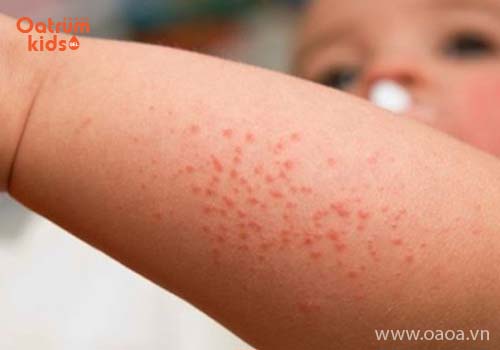 Bé bị rôm sảy bôi thuốc gì cho nhanh khỏi và an toàn?