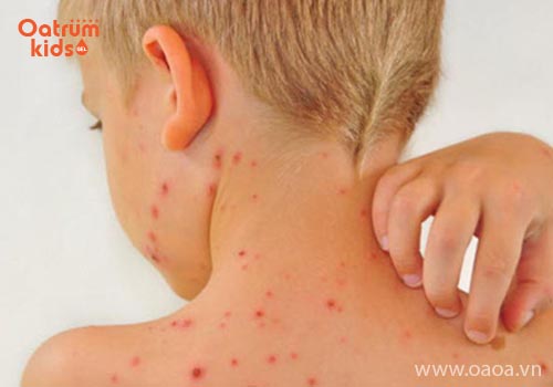 Bé nổi mẩn ngứa khi thay đổi thời tiết