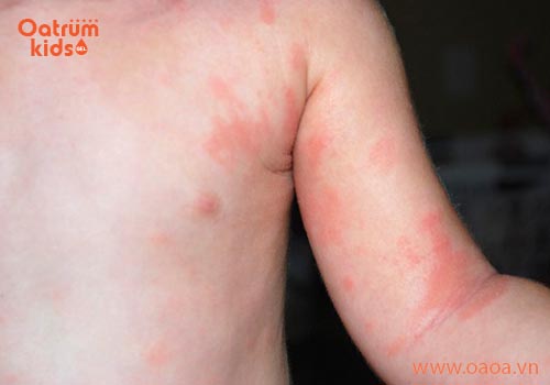 Bé sơ sinh bị nổi mẩn đỏ tắm bằng nước lá gì?