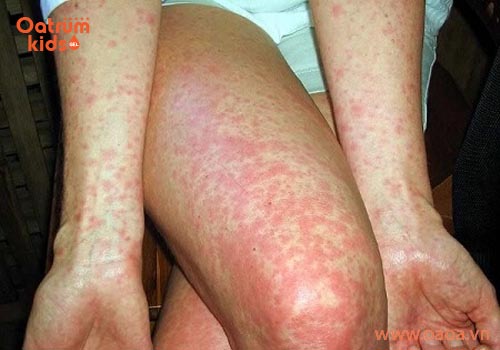 Bệnh mề đay có lây không?