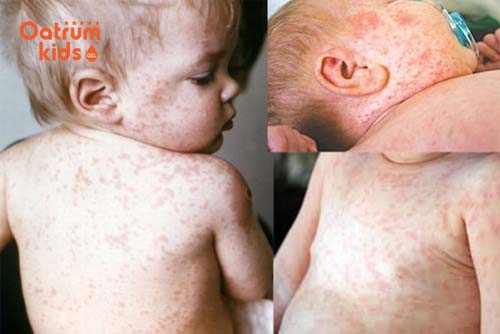 Bệnh sởi ở trẻ tiến triển như thế nào? Cách điều trị bệnh này hiệu quả nhất