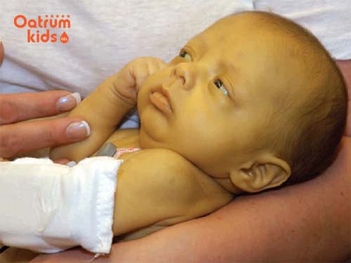 Bệnh vàng da ở trẻ sơ sinh và những biến chứng không thể coi thường