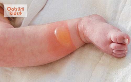 Bị bỏng phồng rộp da xử trí theo cách này ngay