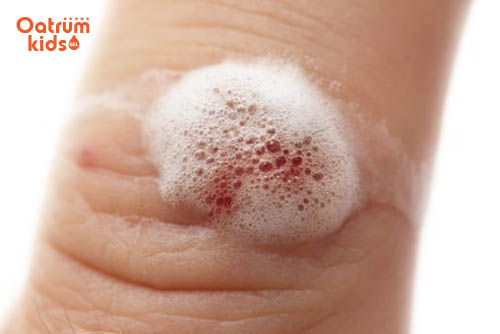 Bôi gì vào vết trầy xước trên da trẻ?