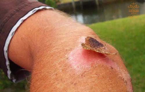 Cách chăm sóc vết thương lên da non chuẩn chuyên gia