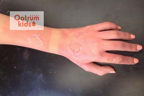 Cách chữa bỏng nhiệt tại nhà hiệu quả 100%